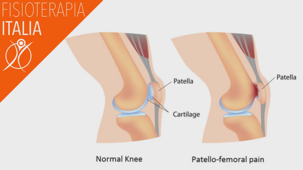 anatomia ginocchio e sindrome femoro rotula