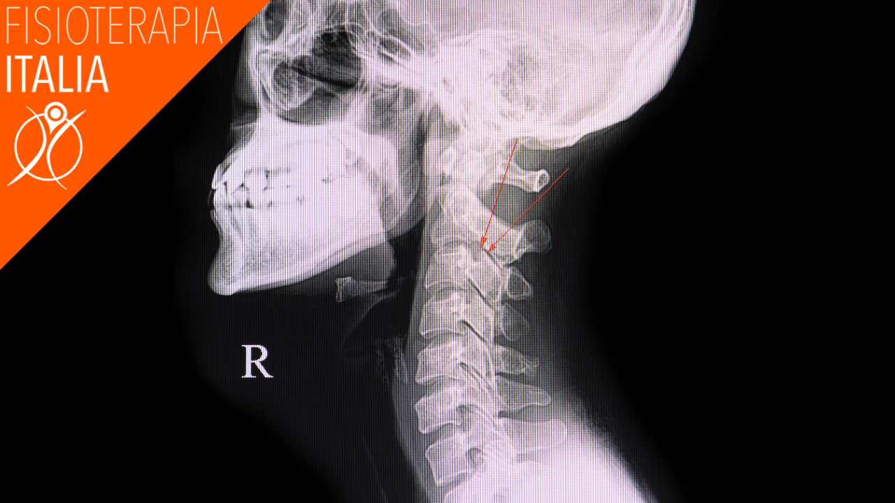 Ernia cervicale, cosa fare cure e rimedi - Fisioterapia Roma: MEDBEN